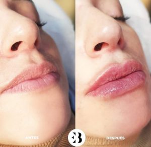 aumento de labios medicina estética madrid