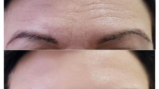 eliminar-arruga-en-la-frente-medicina-estetica-madrid