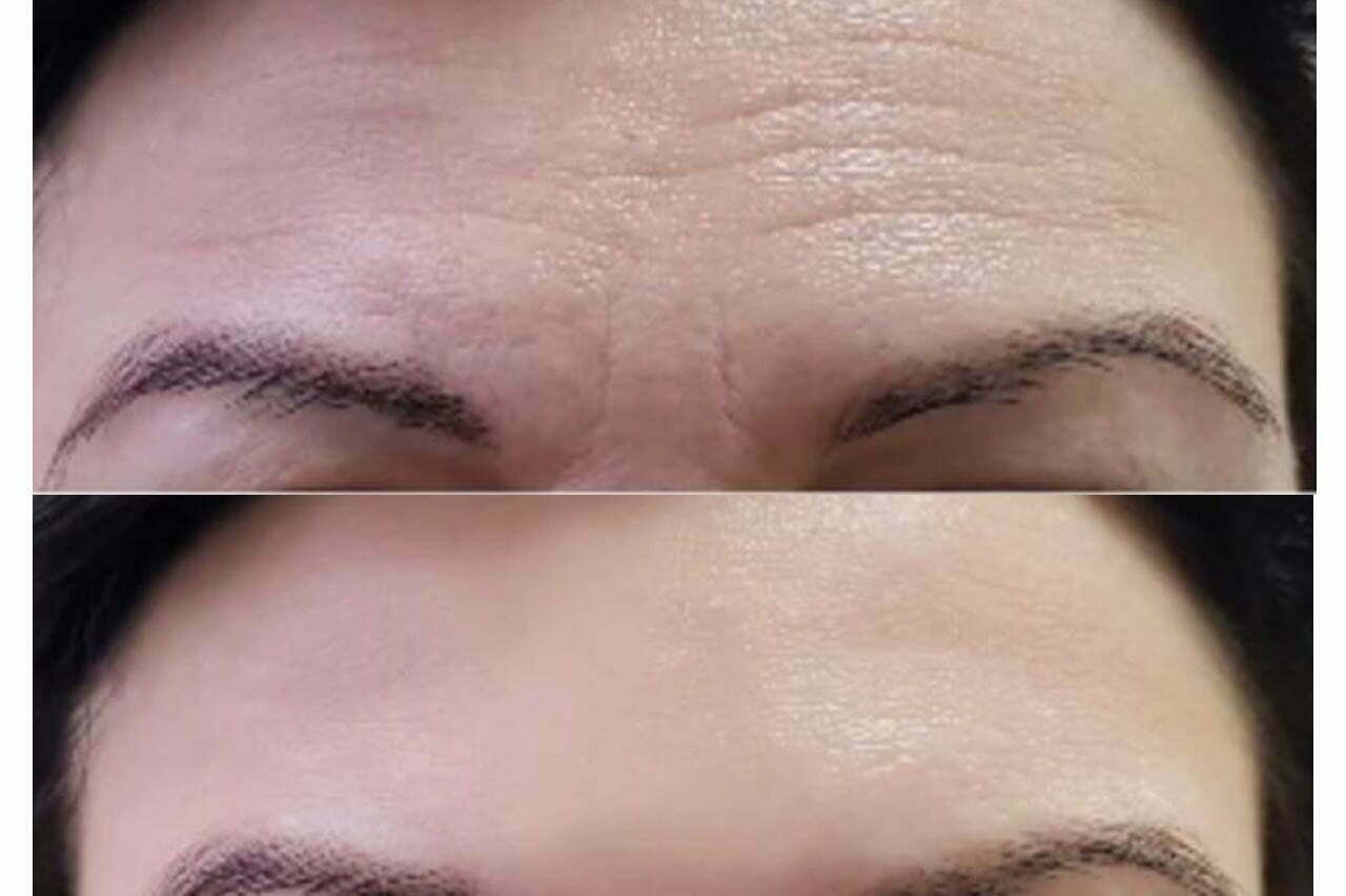 eliminar-arruga-en-la-frente-medicina-estetica-madrid