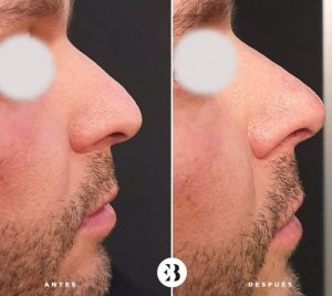 rinomodelación sin cirugía medico estético madrid