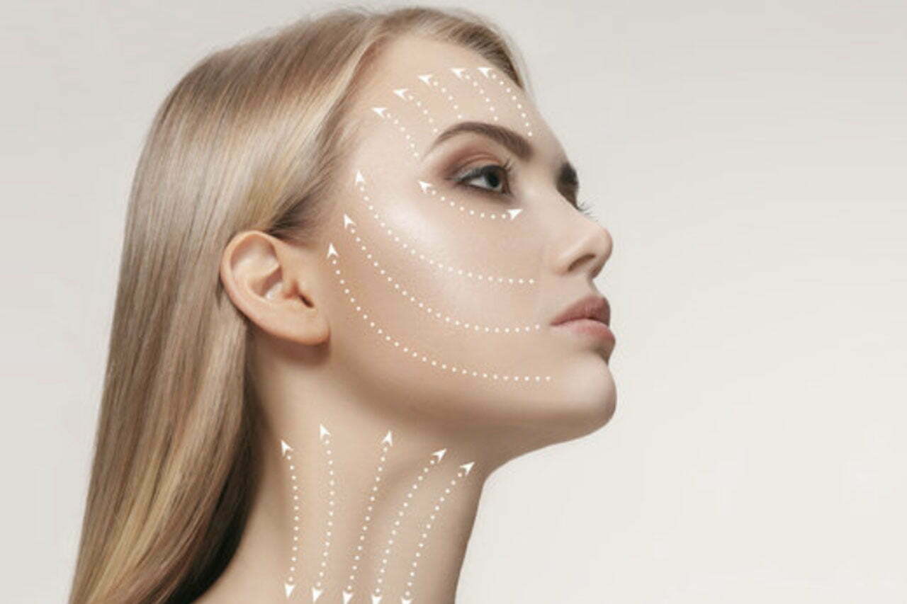 Silhouette Soft hilos tensores medicina estética madrid