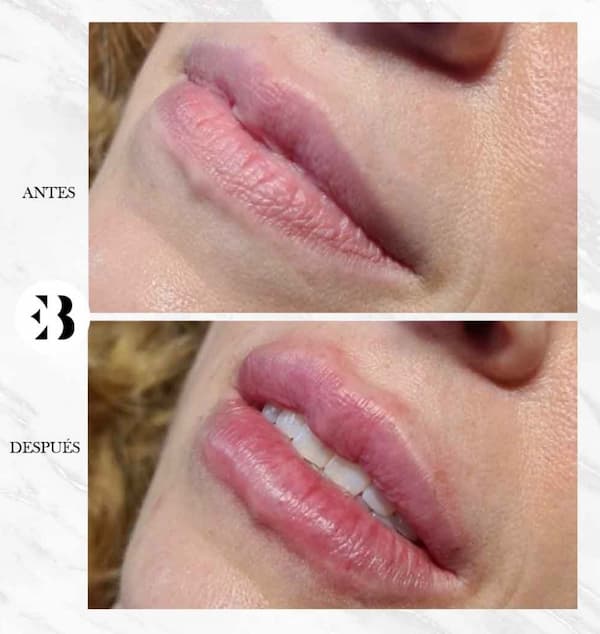 aumento de labios madrid