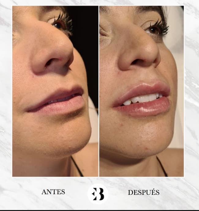 aumento de labios madrid