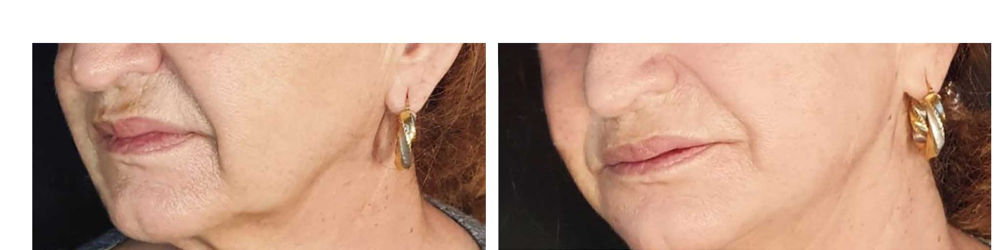 hilos tensores madrid