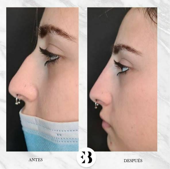 rinomodelación sin cirugía madrid centro