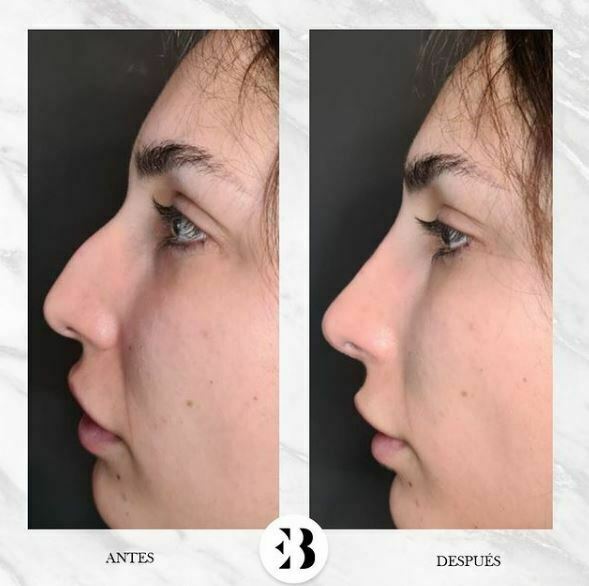 rinomodelación sin cirugía madrid