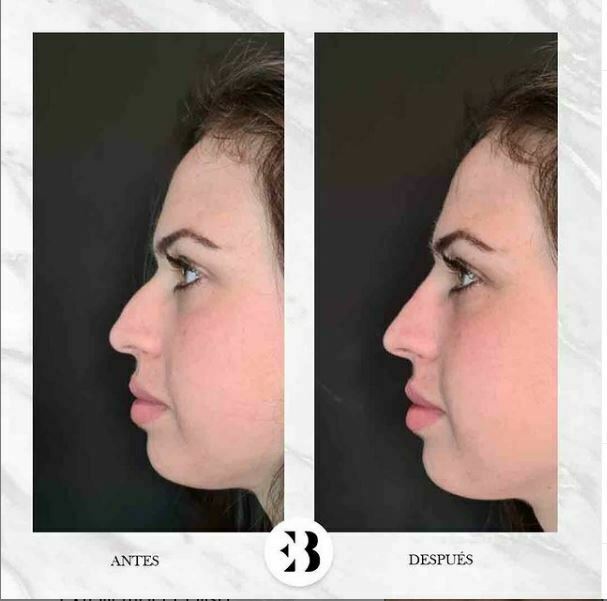 rinomodelacion antes y después