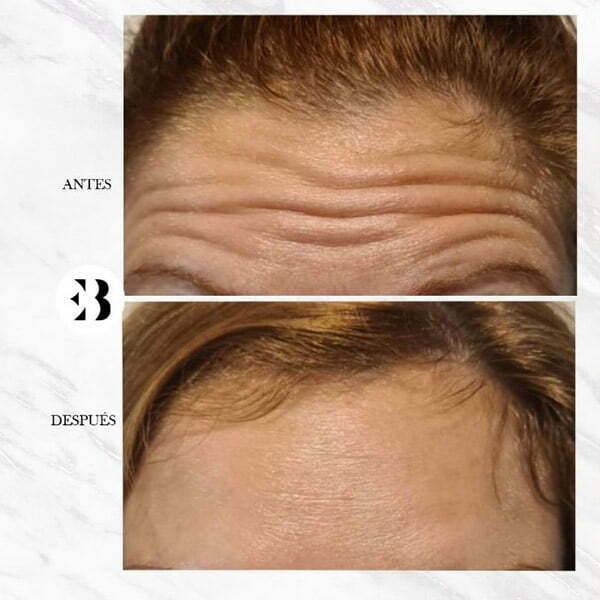 botox antes y despues botox antes y despues