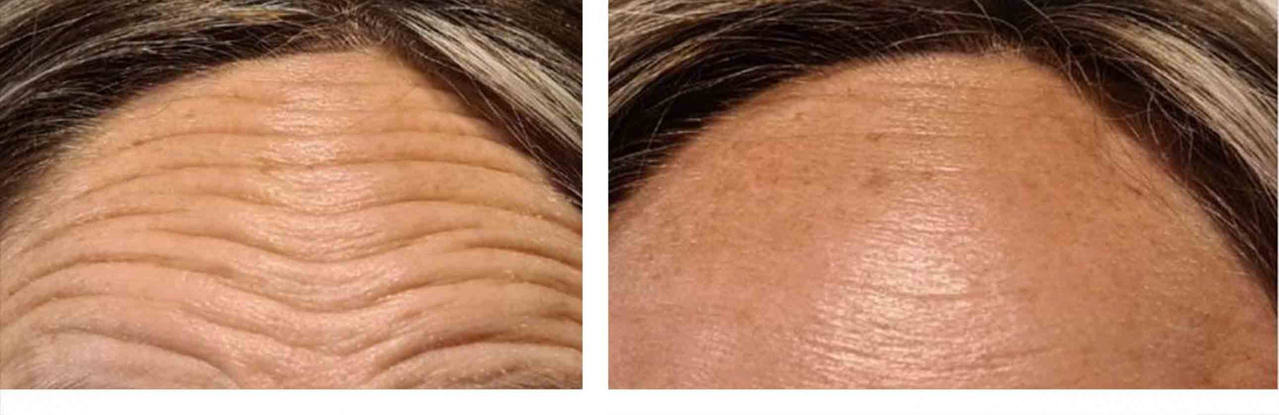 eliminar arrugas frente botox