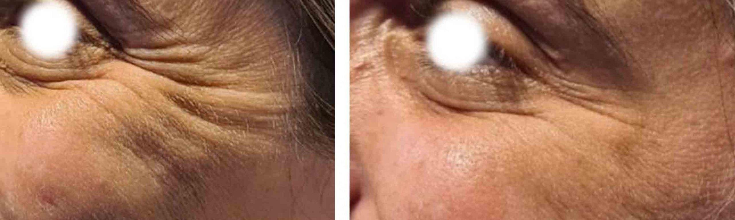 eliminar arrugas pata de gallo