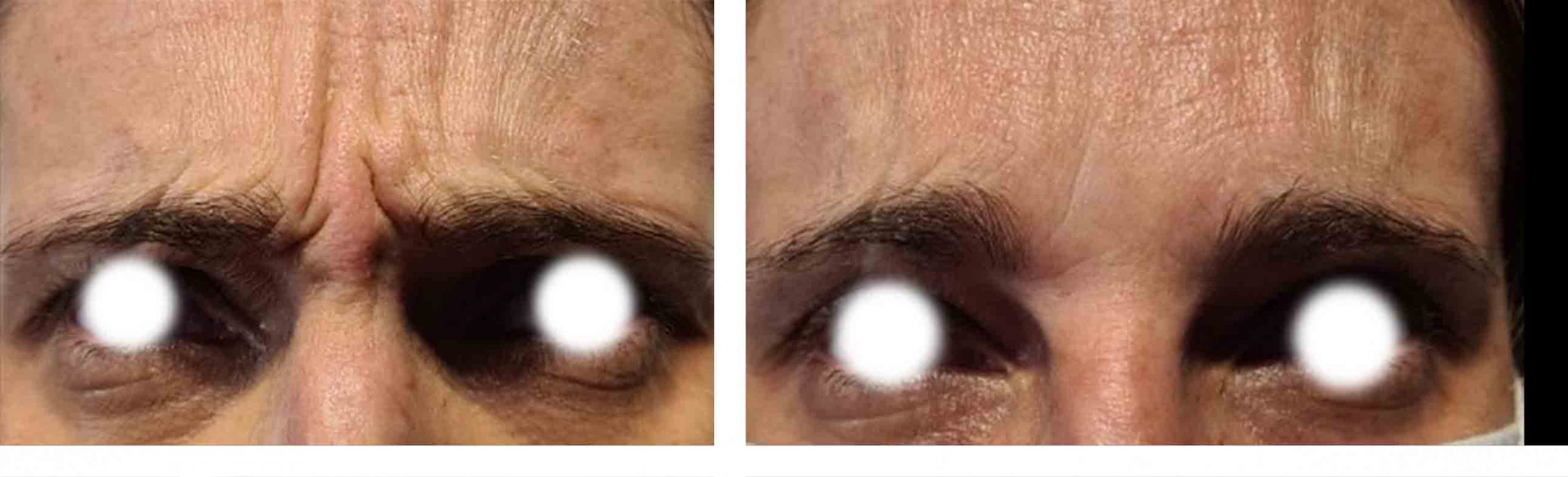 eliminar botox entrecejo