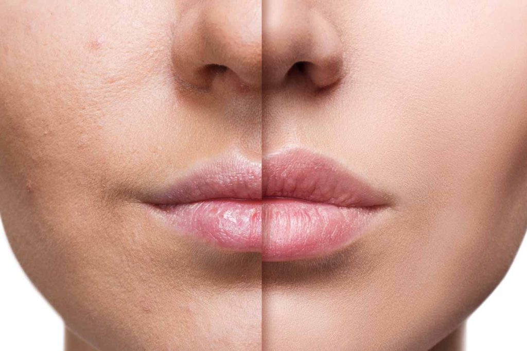 aumento de labios