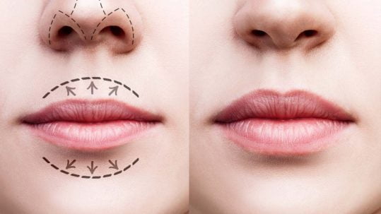 aumento de labios aumento de labios precio aumento de labios con acido hialuronico