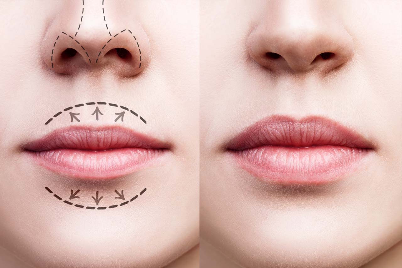 aumento de labios aumento de labios precio aumento de labios con acido hialuronico