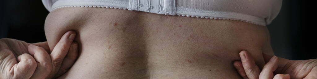mesoterapia grasa localizada