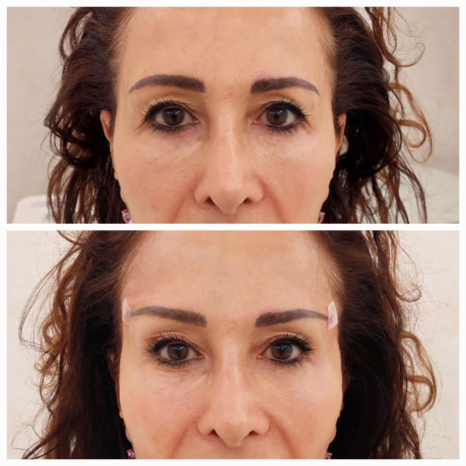 hilos tensores ojos antes y después