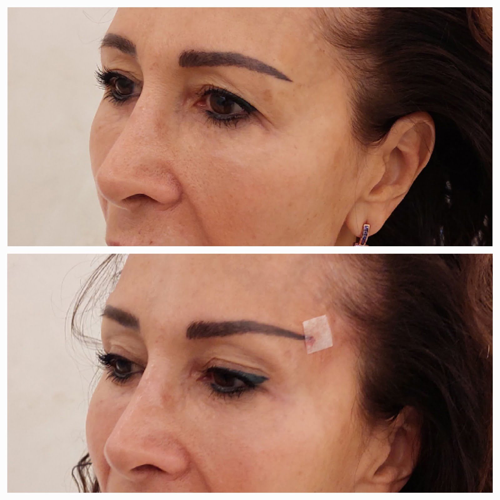 hilos tensores ojos antes y después foxy eyes