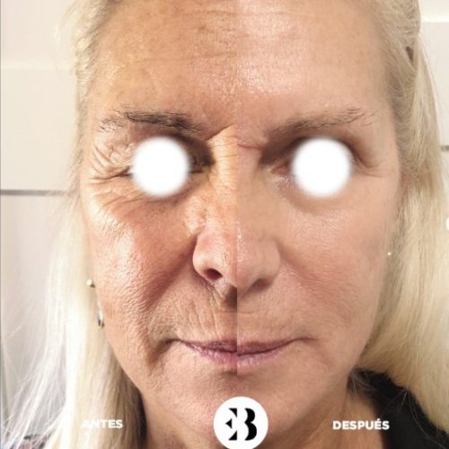 Tratamiento Eliminación de Arrugas con PlexR Pro