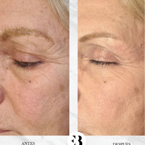 Tratamiento Eliminar Patas de Gallo con PlexR Pro