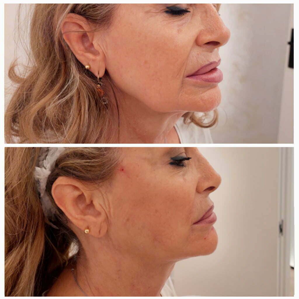 hilos tensores faciales