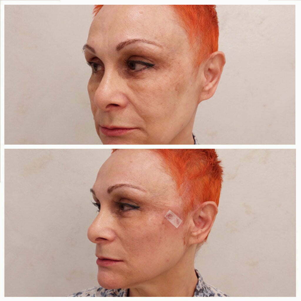 hilos-tensores-ojos-antes-y-despues