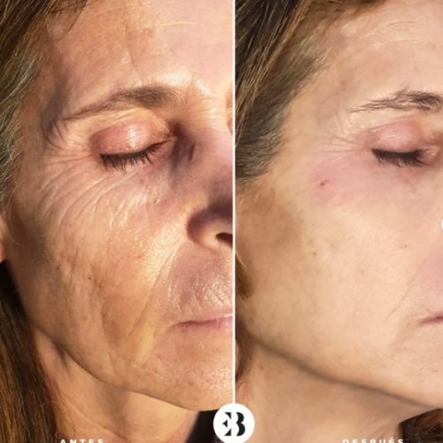 Tratamiento Rejuvenecimiento Facial con PlexR Pro