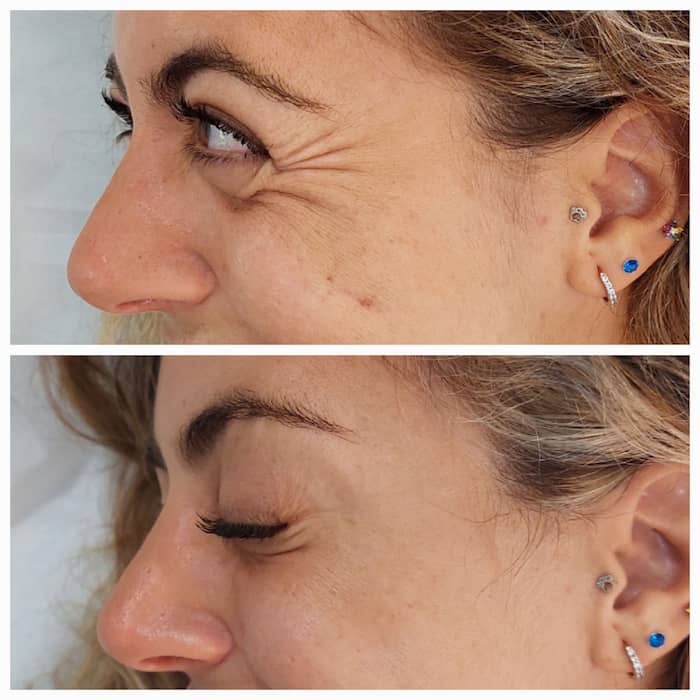 Botox en Patas de gallo, Antes y Después