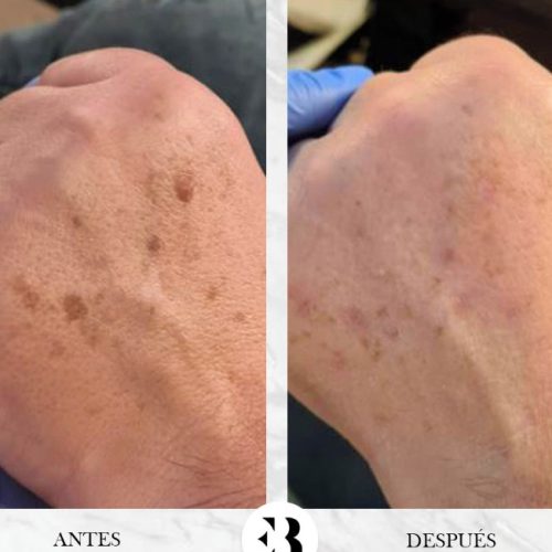 Tratamiento eliminación de manchas, lunares y otras lesiones de piel con PlexR Pro