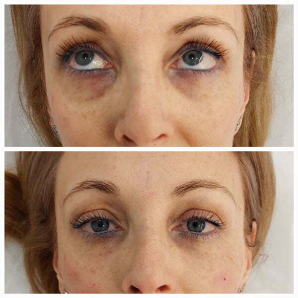 eliminar ojeras en la clínica medicina estética