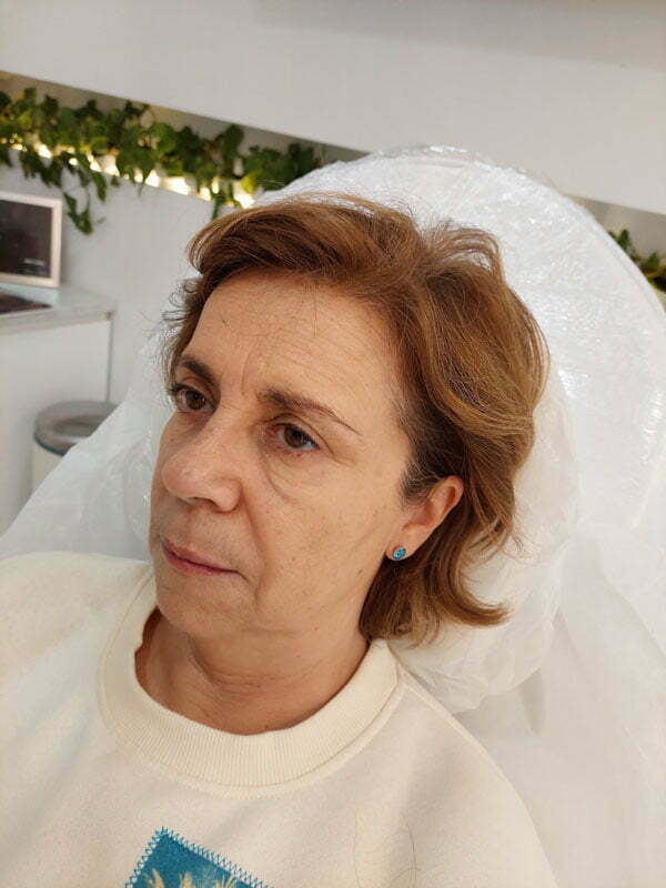 aumento de pomulos antes y después