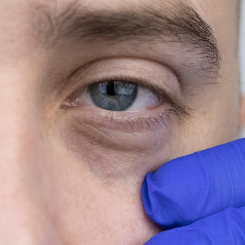 eliminar las ojeras con acido hialurónico en la clinica de medicina estetica EB