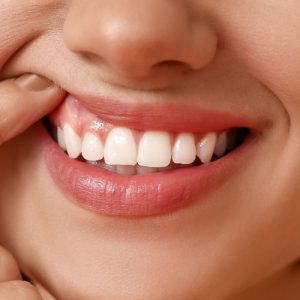 botox sonrisa gingival madrid