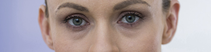 cómo eliminar las ojeras oscuras con ácido hialurónico en la clínica de medicina estética en Madrid cómo eliminar las ojeras oscuras