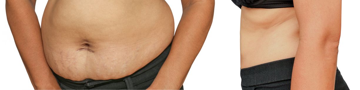 IPOSUCCIÓN SIN CIRUGÍA ANTES Y DESPUÉS: TODO LO QUE DEBES SABER