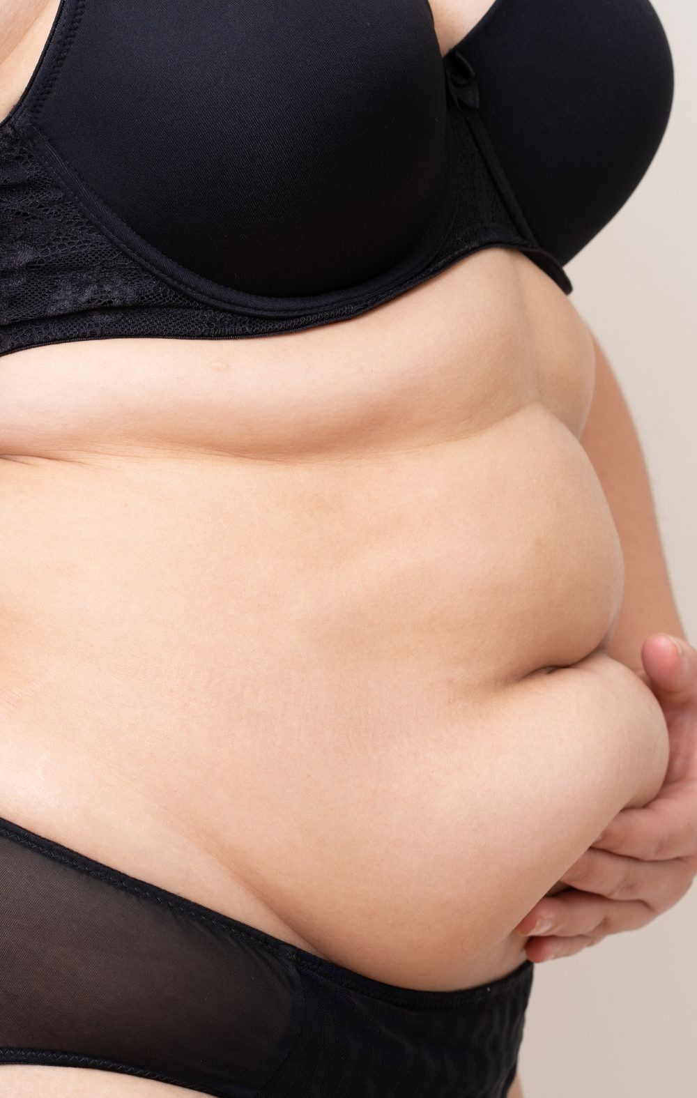 liposucción sin cirugía Antes