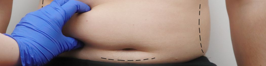 métodos de liposucción sin cirugía