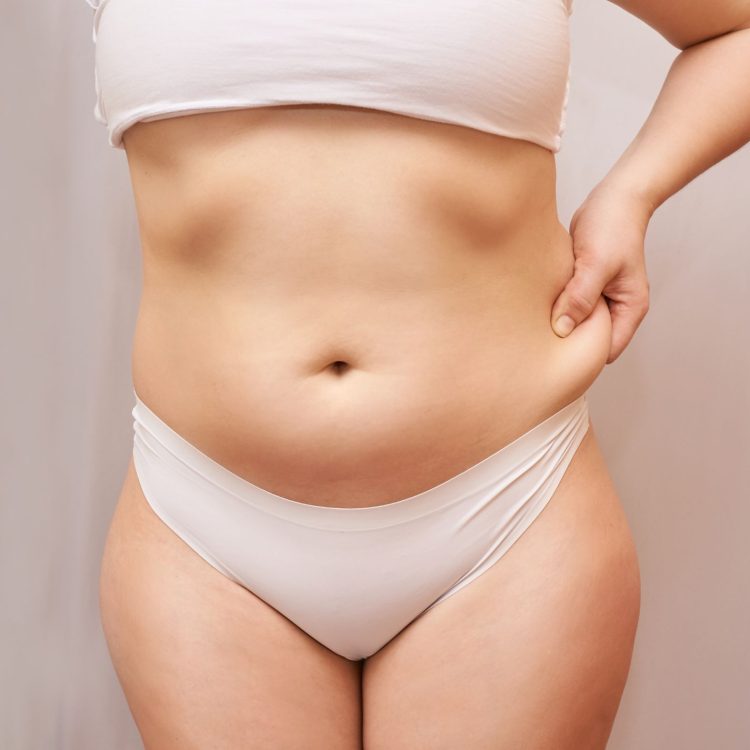 lipo sin cirugía Madrid