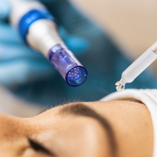 dermapen facia madrid en la clínica de medicina estética de la Dra Elena Berezo