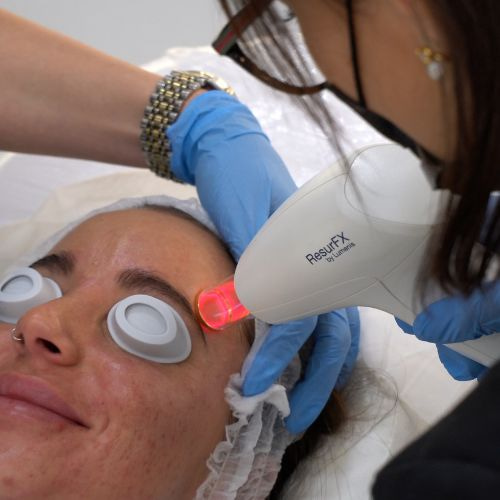 Tratamiento laser Lumenis M22 en Madrid en la Clínica de Medicina Estética Dra Elena Berezo