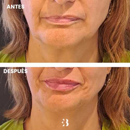 Aumento de Labios Antes y después en la clínica de medicina estética Dra Elena Berezo
