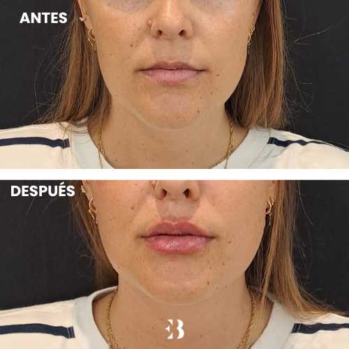Aumento de Labios con acido hialurónico Antes y después del tratamiento.