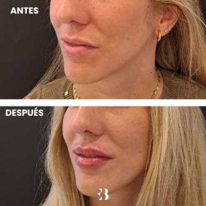 Antes y después del tratamiento de ácido hialurónico para los labios en la clínica de medicina estética Dra Elena Berezo