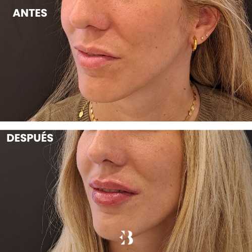 Antes y después aumento de labios con ácido hialurónico