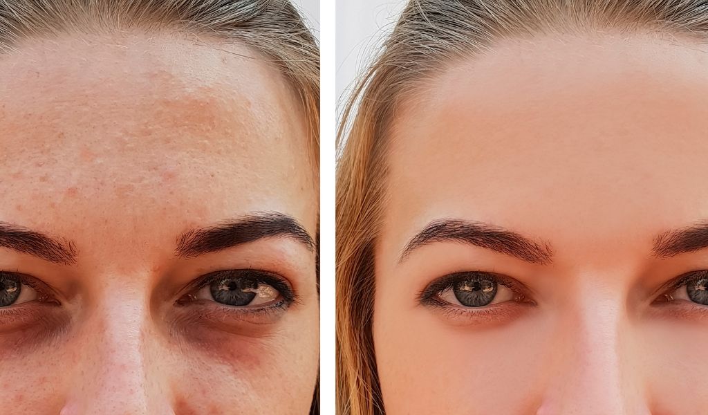 Antes y después tratamiento reducir ojeras con ácido hialurónico