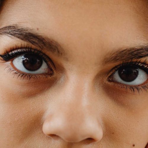 eliminar ojeras y bolsas Tratamiento de relleno de ojeras con acido hialuronico