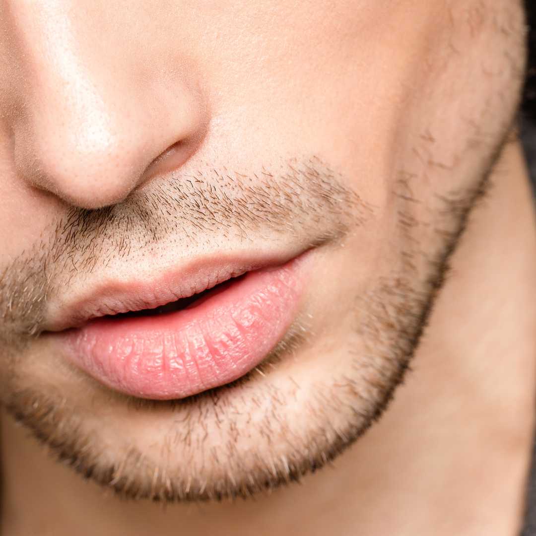 Marcación mandibular hombre con ácido hialurónico en la clínica de medicina estética Dra Elena Berezo