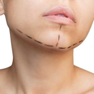 marcar mandíbula con ácido hialurónico