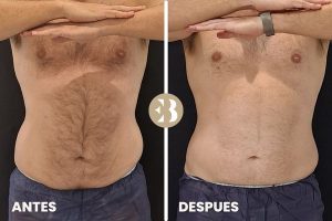 antes y después criolipolisis abdomen