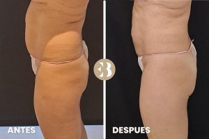antes y después coolsculpting abdomen