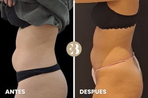 antes y después criolipolisis abdomen